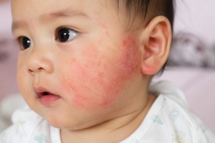 Vị trí chàm sữa thường gặp ở trẻ sơ sinh