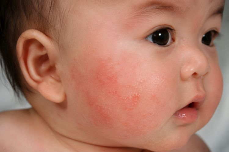 Chàm sữa có thể bùng phát theo từng đợt