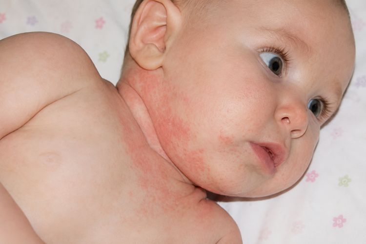 Các yếu tố khiến chàm sữa biểu hiện rõ hơn