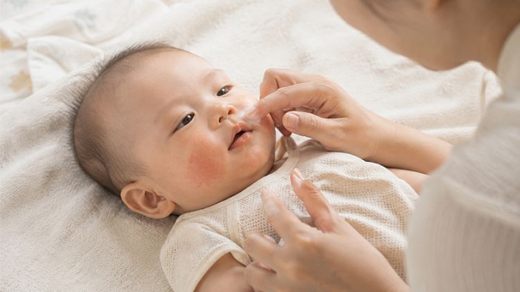 Xử lý ban đầu khi trẻ có dấu hiệu chàm sữa