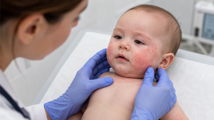 Dấu hiệu chàm sữa cần đưa trẻ đi khám