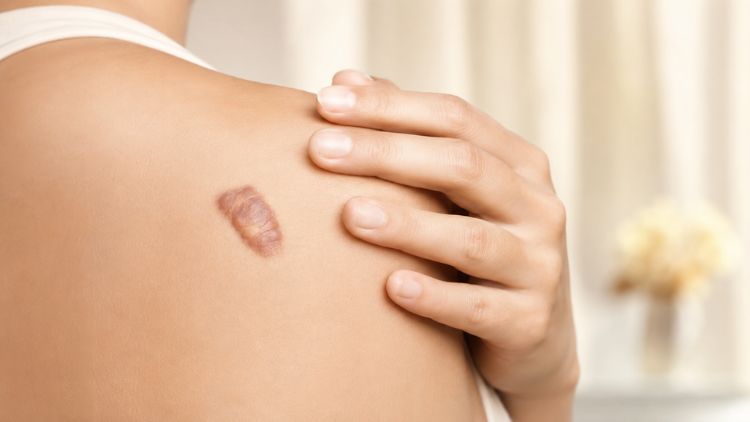 Lựa chọn phương pháp điều trị cần dựa trên từng loại sẹo