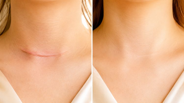 Phối hợp nhiều phương pháp giúp tối ưu hiệu quả điều trị sẹo