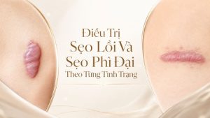 Điều Trị Sẹo Lồi Và Sẹo Phì Đại: Chọn Phương Pháp | Citrine