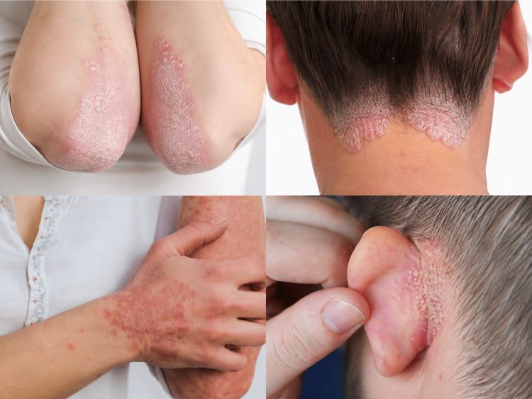 Cần kiểm soát vảy nến trước khi cân nhắc trẻ hóa da