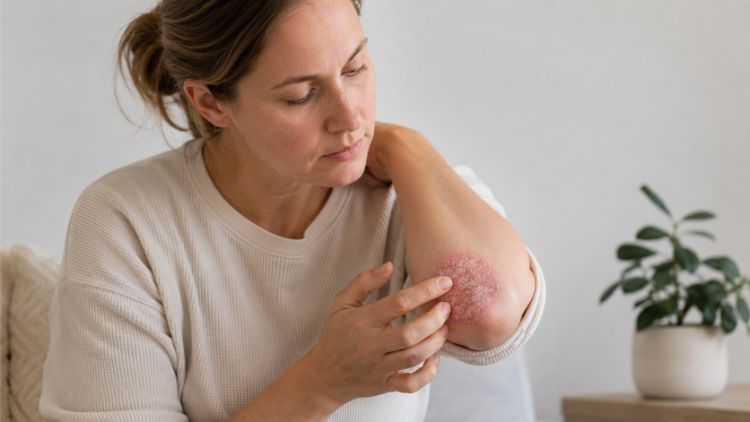 Da có thể vẫn khô, sần hoặc không đều màu sau khi vảy nến giảm