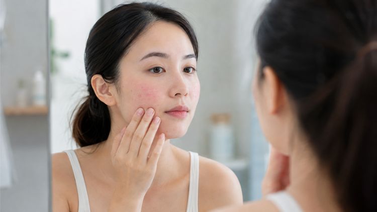 Sưng đỏ nhẹ sau điều trị mụn có thể là phản ứng tạm thời của da