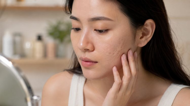 Sẹo lõm có thể khiến bề mặt da kém mịn