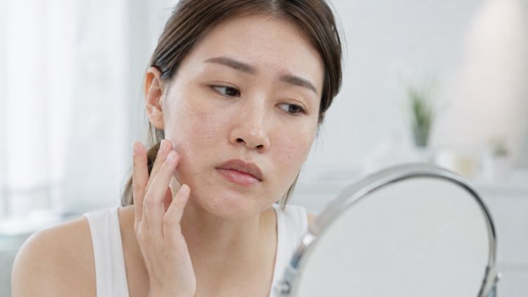 Da khô căng và nhanh mất ẩm có thể kèm bong nhẹ, thô ráp hoặc châm chích