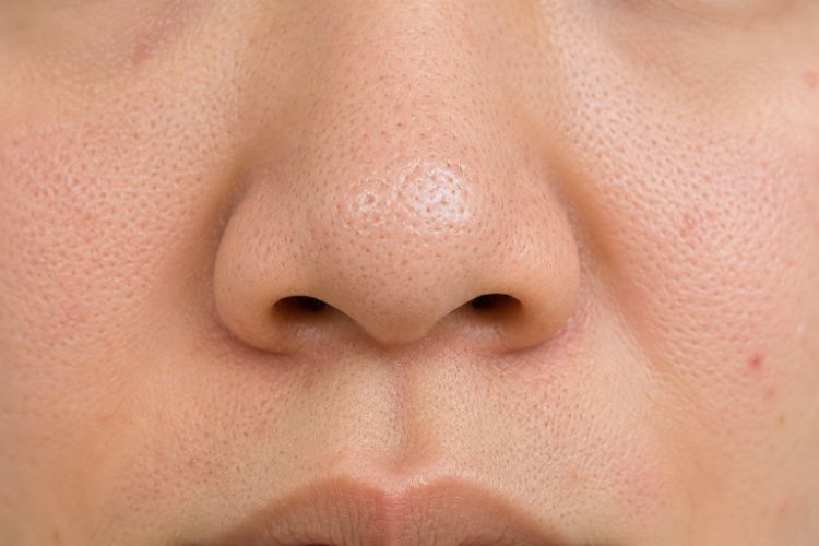 Khả năng và giới hạn khi cải thiện lỗ chân lông