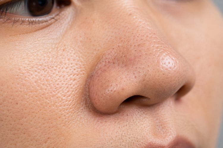 Dầu thừa và bít tắc làm lỗ chân lông rõ hơn
