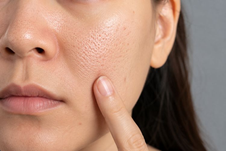 Da giảm đàn hồi khiến lỗ chân lông dễ lộ rõ