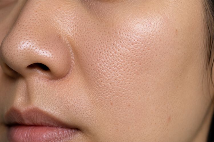 Mụn làm thay đổi kết cấu và bề mặt da
