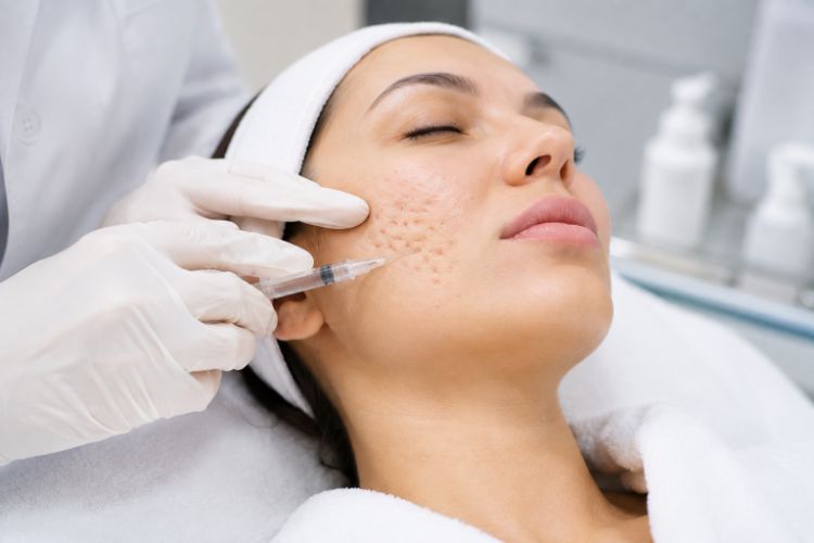 Những trường hợp có thể cân nhắc Meso hỗ trợ da sau mụn