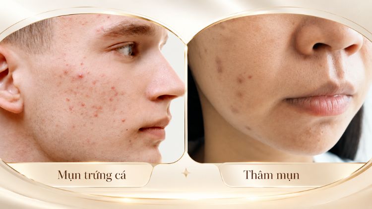 Phân biệt mụn đang hoạt động và thâm sau mụn