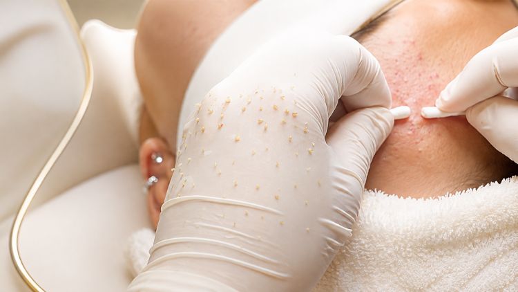 Lấy nhân mụn đúng kỹ thuật giúp bảo vệ làn da