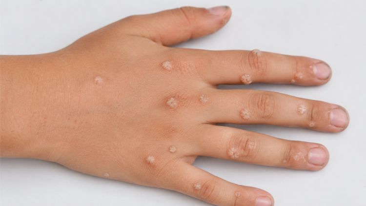 Virus HPV xâm nhập qua vùng da bị tổn thương