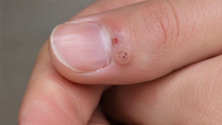 Các yếu tố làm tăng nguy cơ xuất hiện mụn cóc