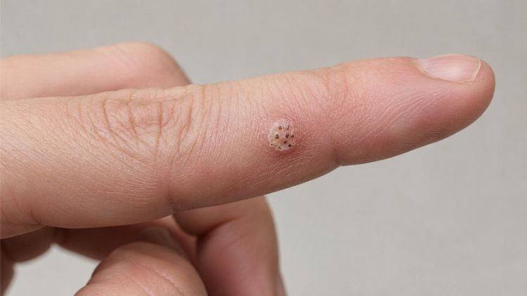 Các dấu hiệu nhận biết mụn cóc ở giai đoạn sớm