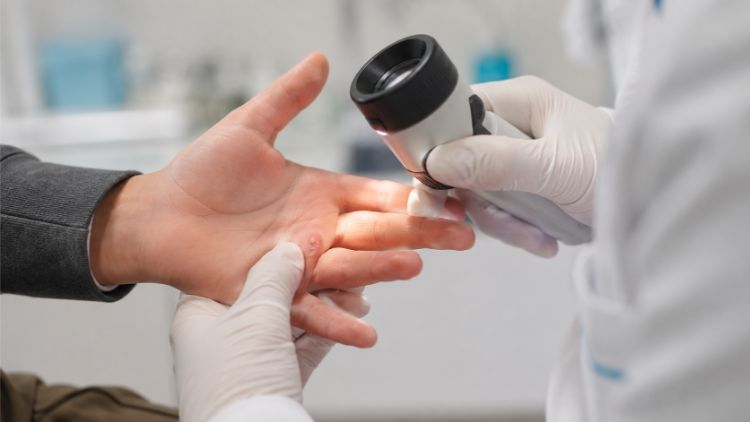 Dấu hiệu mụn cóc cần được bác sĩ kiểm tra