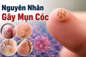 Nguyên Nhân Gây Mụn Cóc: HPV Lây Lan Ra Sao? | Citrine