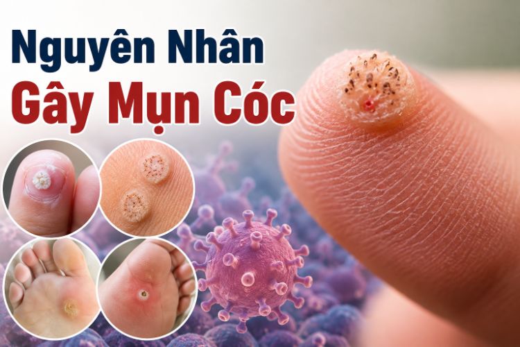 Nguyên Nhân Gây Mụn Cóc: HPV Lây Lan Ra Sao? | Citrine