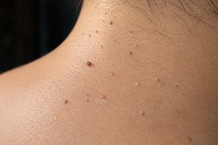 Các tế bào ống tuyến mồ hôi phát triển tạo thành mụn thịt