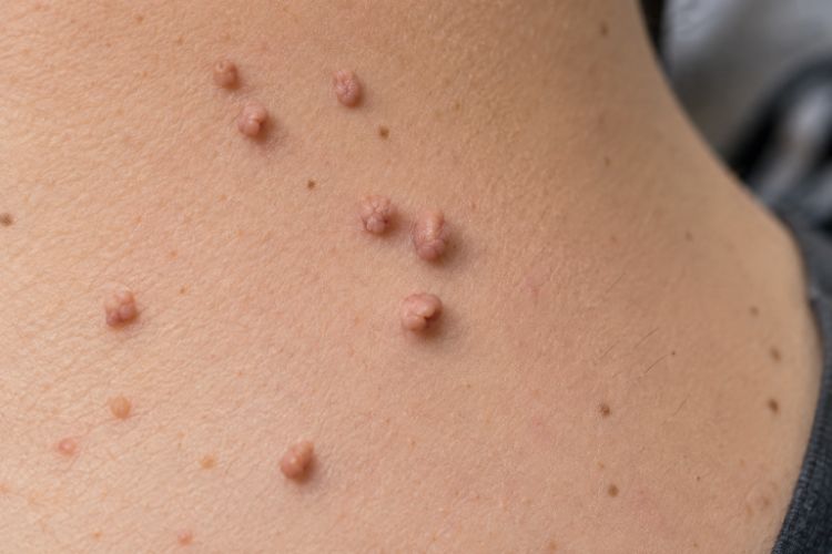 Những nhóm có khả năng xuất hiện mụn thịt cao hơn
