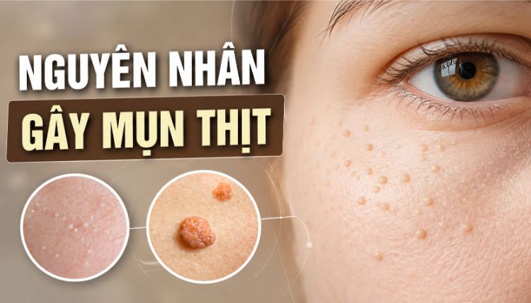 Nguyên Nhân Gây Mụn Thịt Và Cách Nhận Biết | Citrine