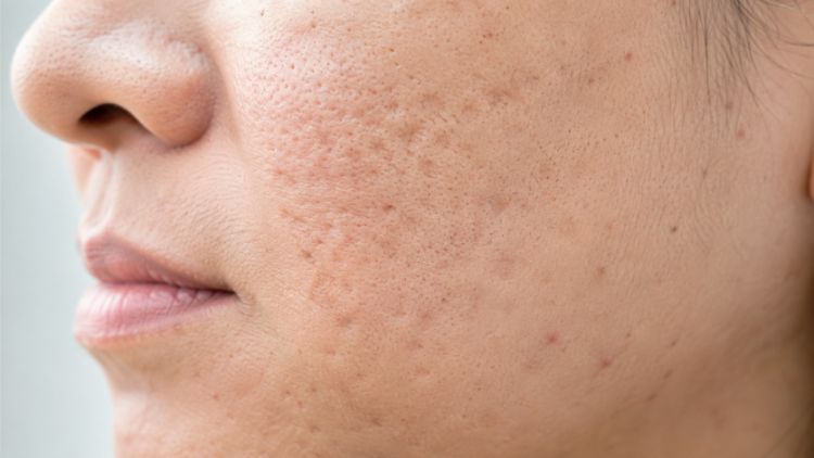 Đặc điểm của sẹo lõm trên da
