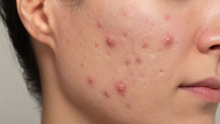 Dấu hiệu da có nguy cơ để lại sẹo lõm