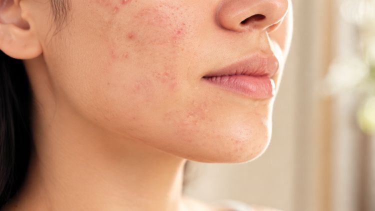 Ưu tiên kiểm soát mụn để hạn chế viêm và hình thành sẹo mới