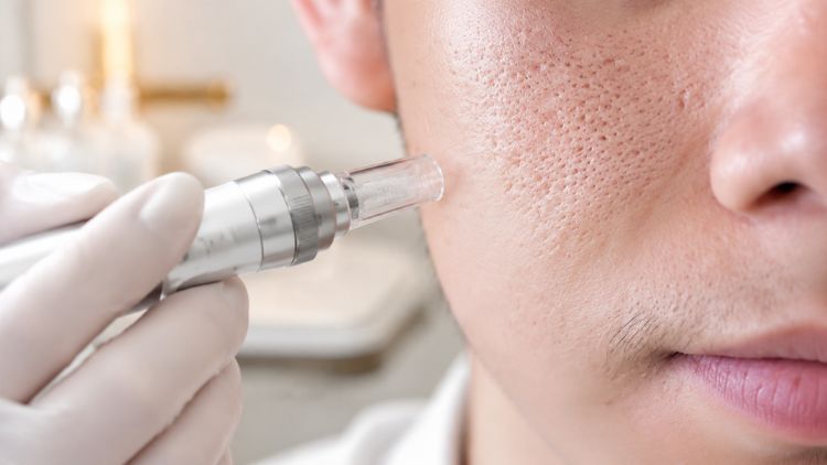 Khi mụn ổn định, có thể chuyển trọng tâm sang điều trị sẹo