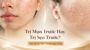 Trị mụn trước hay trị sẹo trước? Ưu tiên nào | Citrine