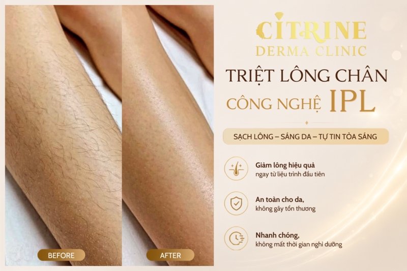 triệt lông ipl