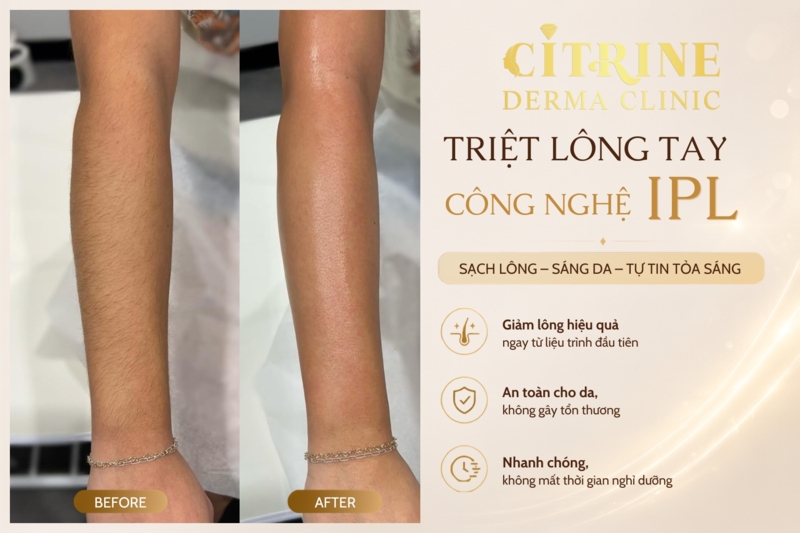 triệt lông ipl