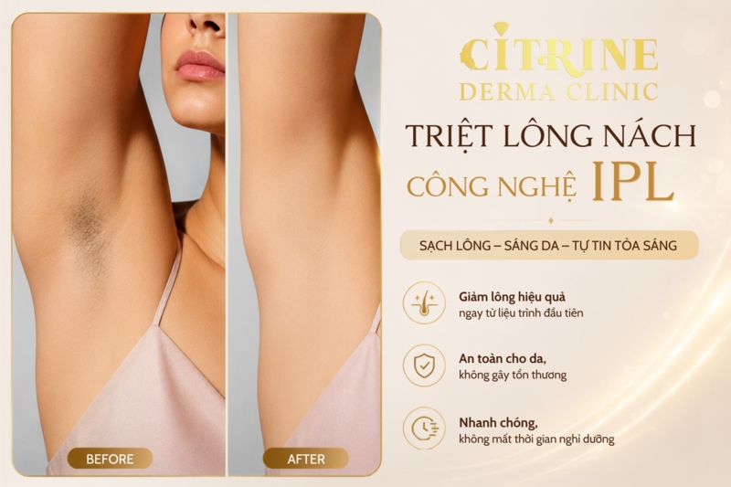 triệt lông ipl