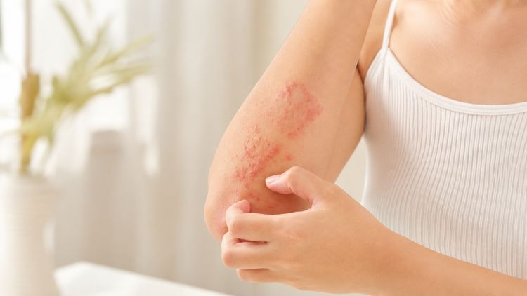Viêm da cơ địa gây khô da, ngứa và dễ tái phát