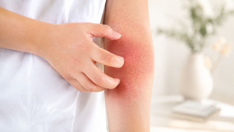 Khô da và ngứa là dấu hiệu điển hình của viêm da cơ địa