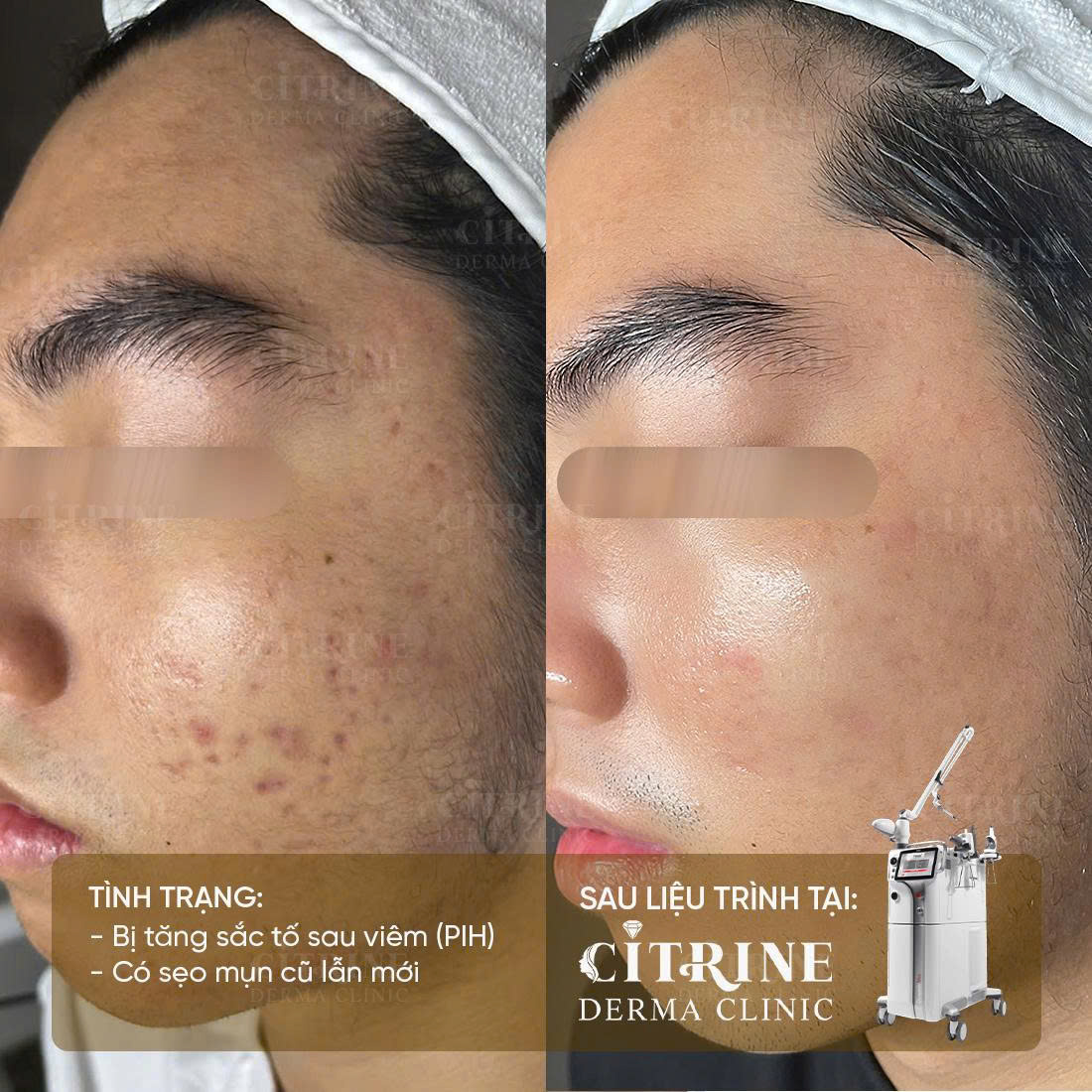 Kết quả liệu trình điều trị nám tại Citrine - trường hợp 4