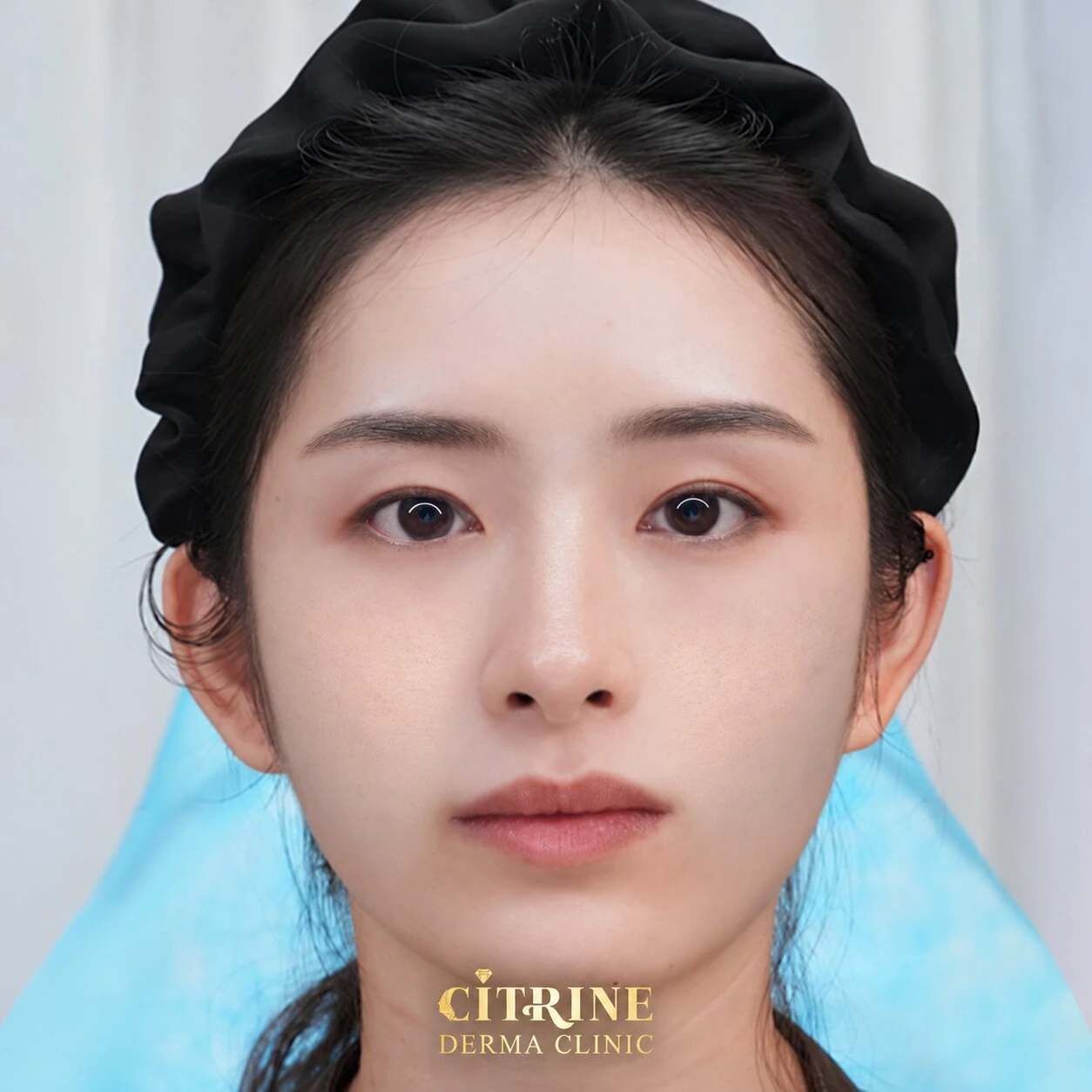 Tiêm Filler full face - ảnh after thực tế, ca 4
