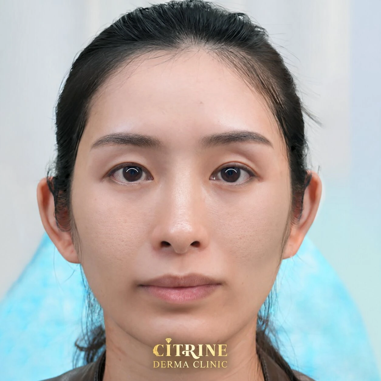 Tiêm Filler full face - ảnh before thực tế, ca 4