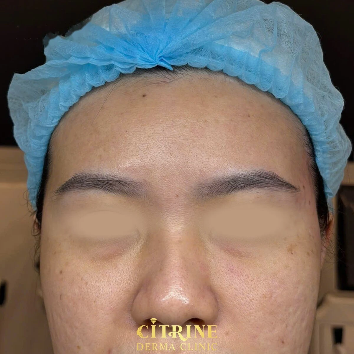 Tiêm filler thái dương - ảnh after thực tế, ca 3