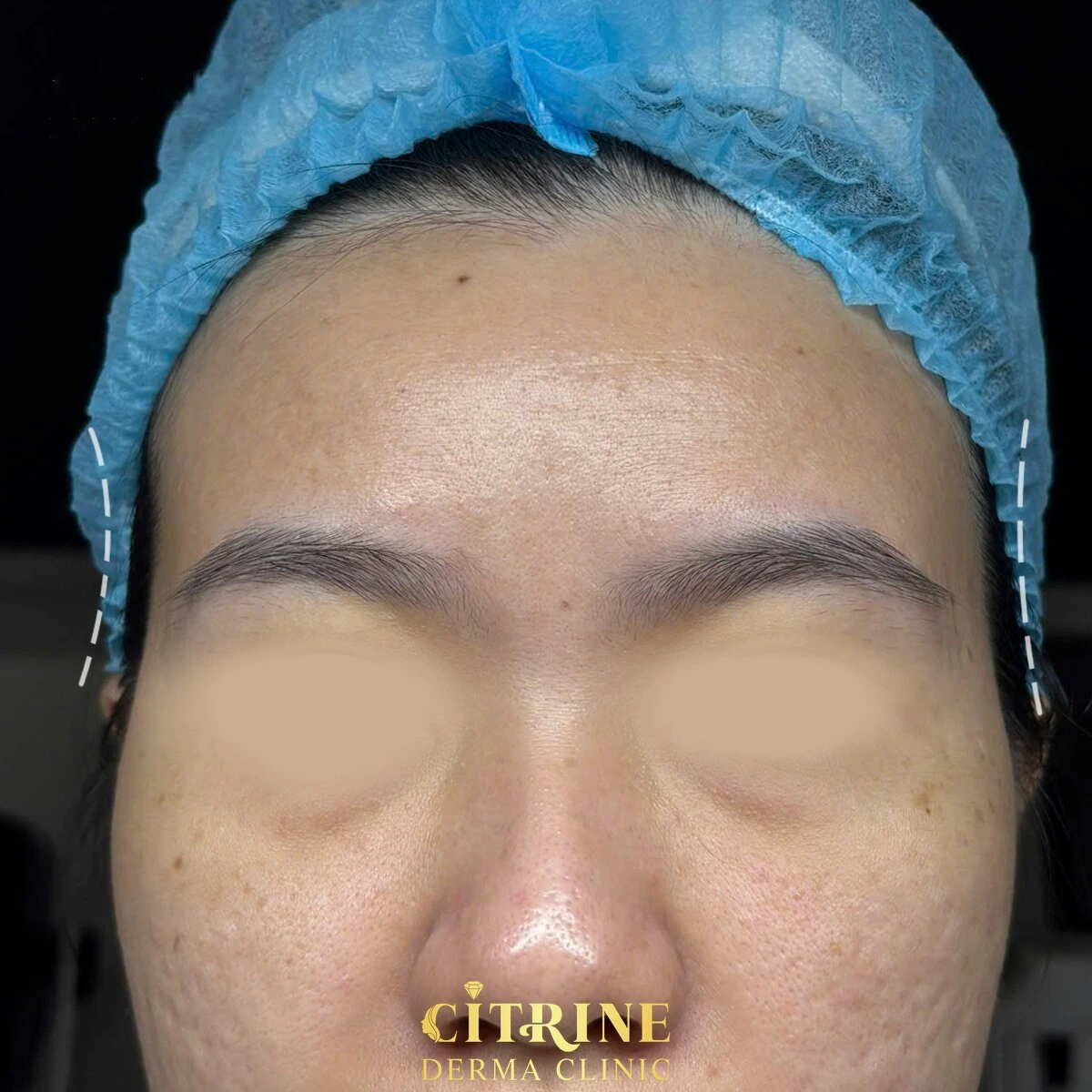 Tiêm Filler thái dương - ảnh before thực tế, ca 3