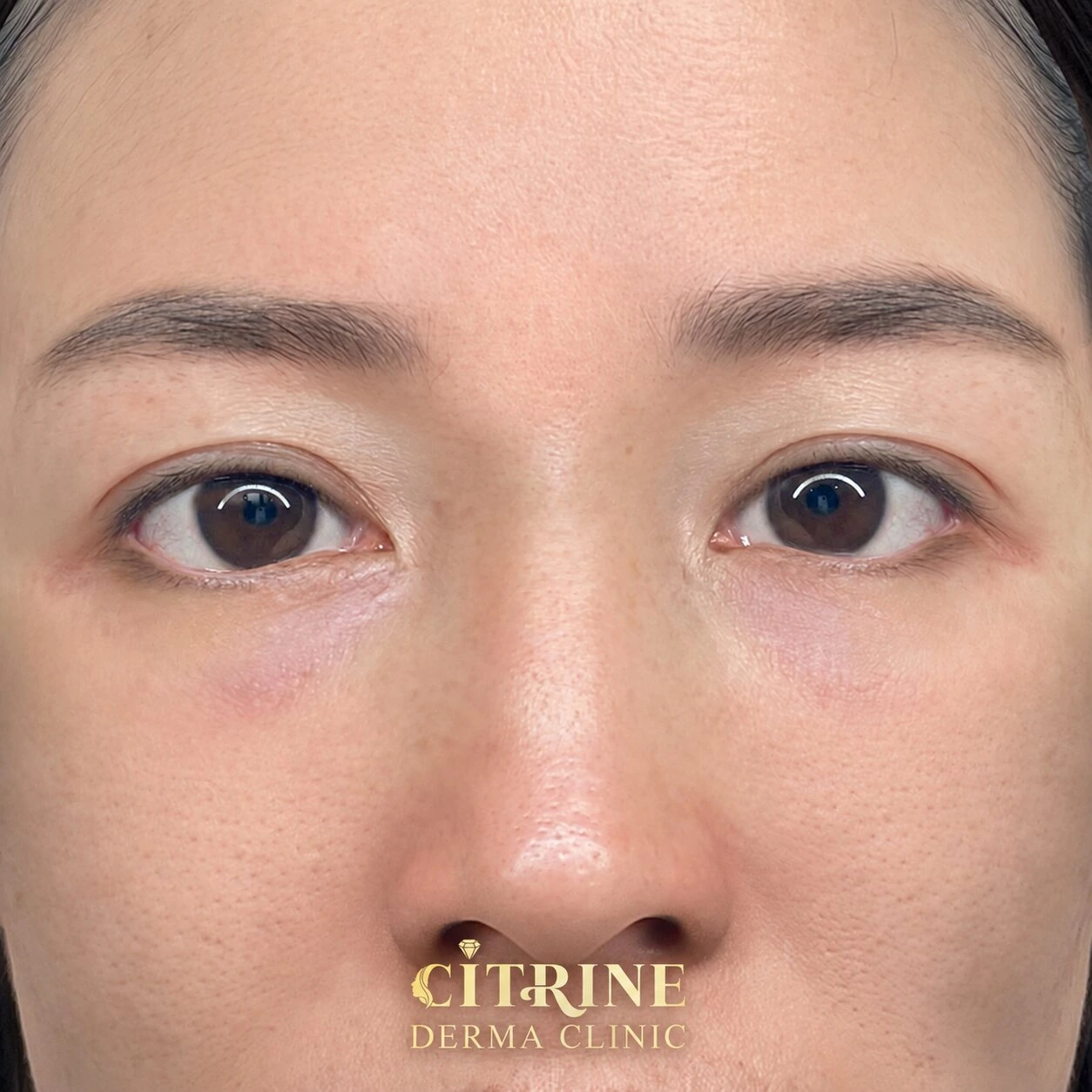 Filler trũng mắt - ảnh after thực tế, ca 2