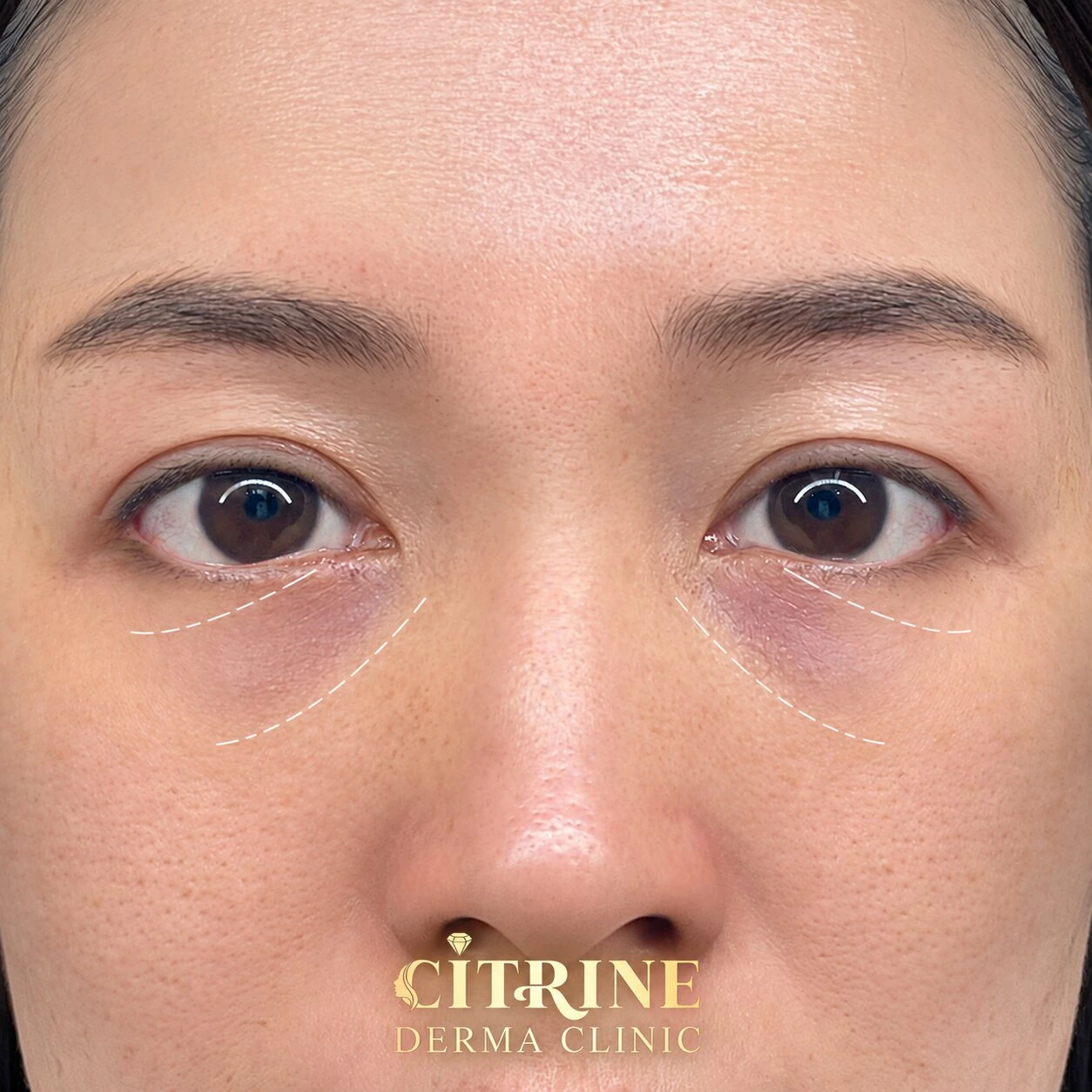 Filler trũng mắt - ảnh before thực tế, ca 2