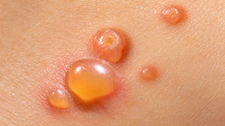 Chốc bọng nước gây bọng chứa dịch, dễ vỡ và để lại vùng da trợt