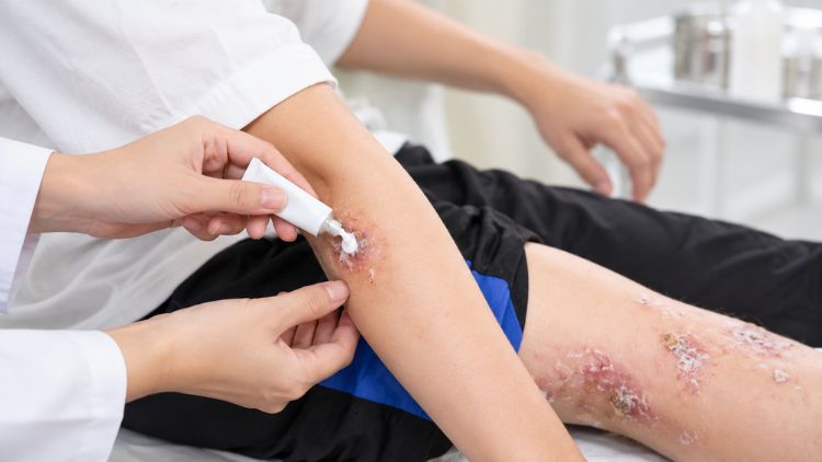 Điều trị chốc có thể dùng thuốc sát khuẩn, kháng sinh bôi hoặc uống theo chỉ định