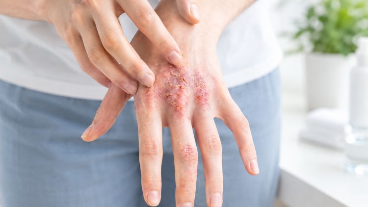 Chốc lan rộng, sưng nóng, đau nhiều cần được khám sớm