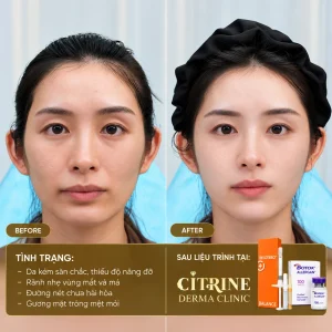 Tiêm filler baby